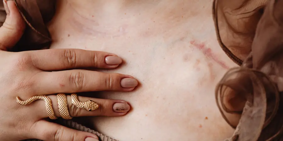 Co-Occurring-Disorders-Bruised-Skin