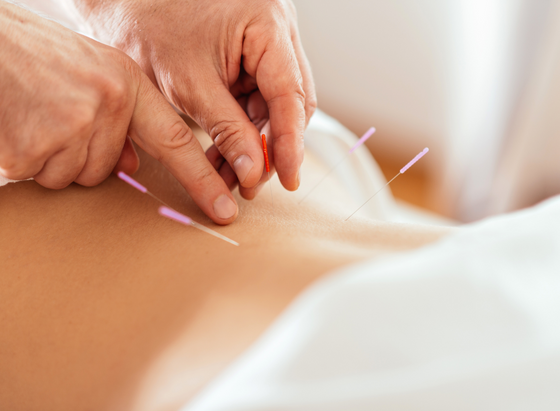 Person receiving acupuncture treatment